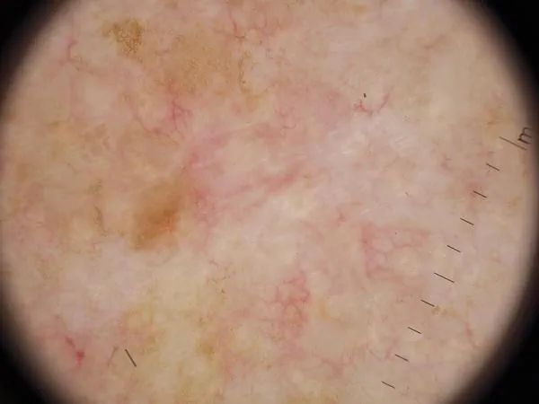 Dermoscopic image: Basal cell carcinoma on the trunk of a 75-year-old man. Both models answered correctly.