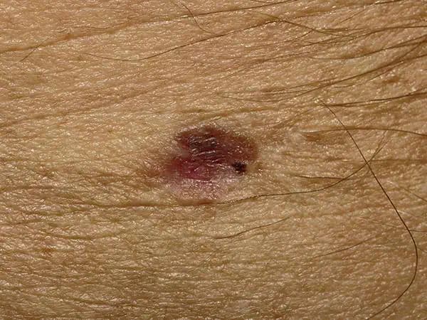 Clinical photograph: Invasive melanoma under 0.8 mm thick, with very little pigment. GPT-6 Astra called it a basal cell carcinoma with 95% confidence.